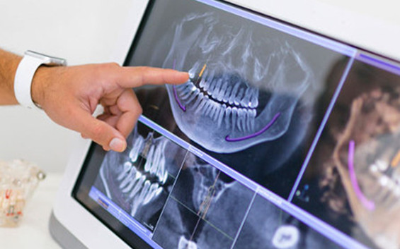 implantologia computer guidata | Studi Mezzena | Dentista a Brescia