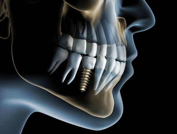 Implantologia Computer Guidata | Studi Mezzena | Dentista a Brescia