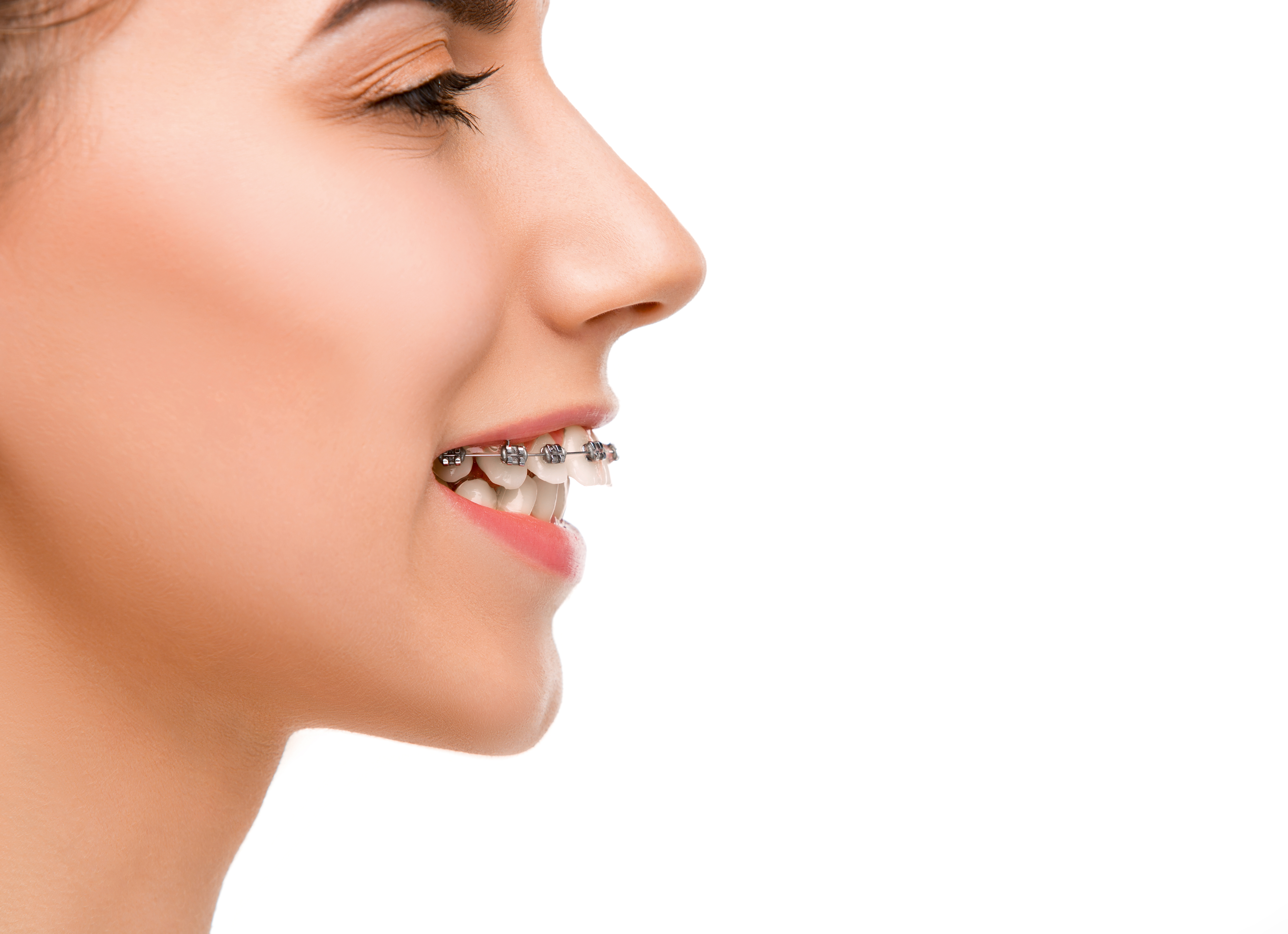 Apparecchio ortodontico | Studi Mezzena | Dentista a Brescia