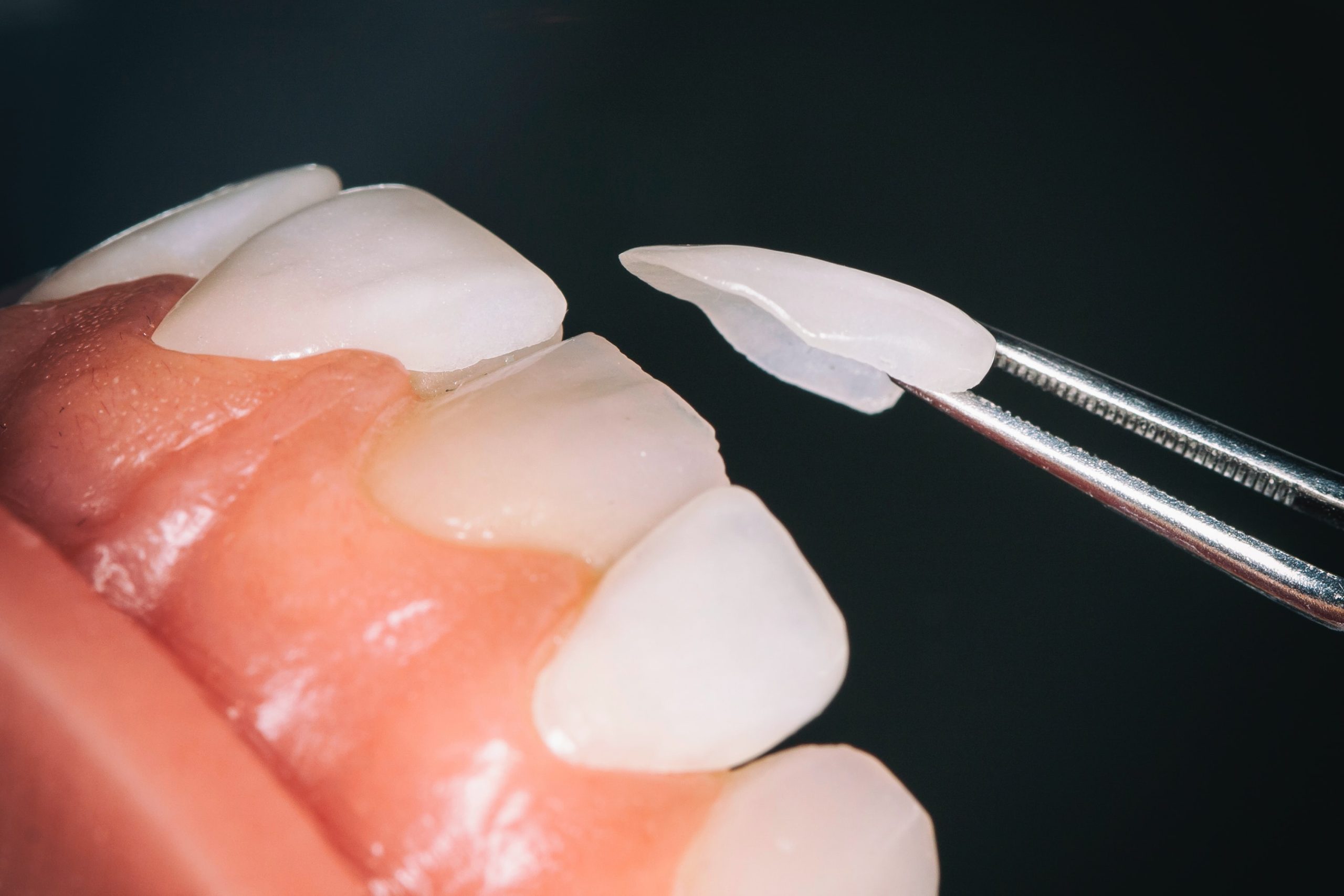 Obiettivo-sorriso-perfetto_rispondiamo-alle-domande-sulle-faccette-dentali2