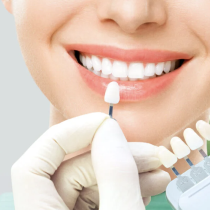 Faccette dentali Blog Studi Mezzena